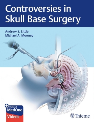 Controversies in Skull Base Surgery