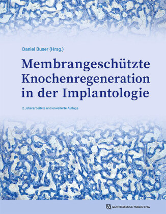 Membrangeschützte Knochenregeneration in der Implantologie